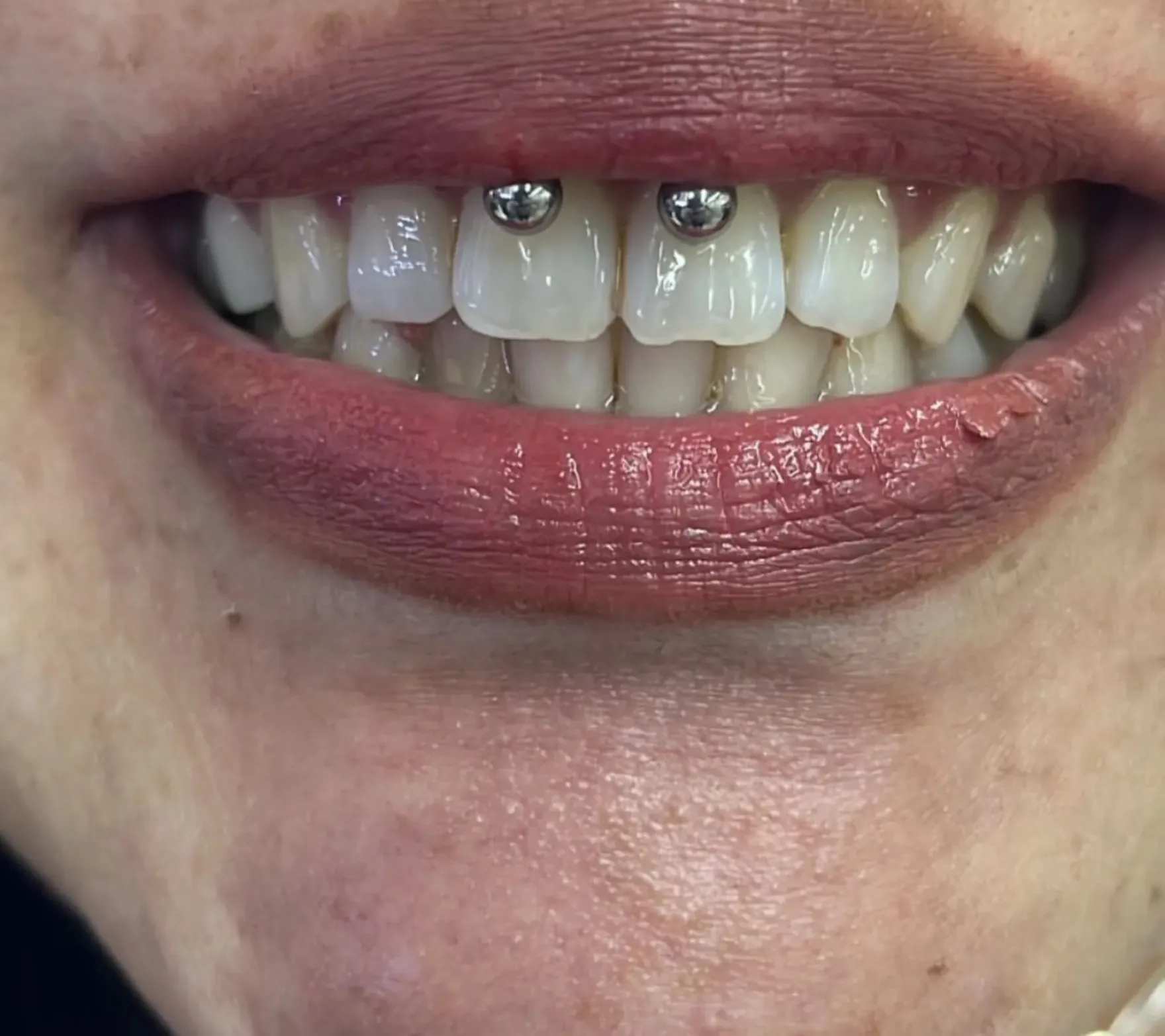 Smiley piercing by Wheels at Golden Child Tattoo in Escondido
